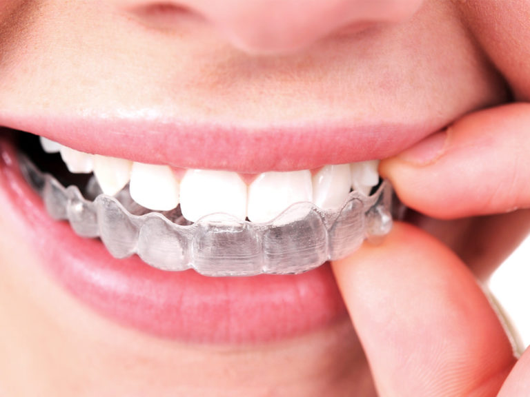 Invisalign©  Docteur David Stain  Chirurgien dentiste