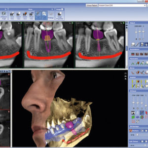 logiciel de planification implantaire - équipements innovants docteur stain dentiste à La Rochelle